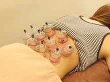 カッピング施術